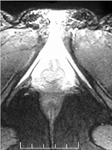 The first MRI of the clitoris